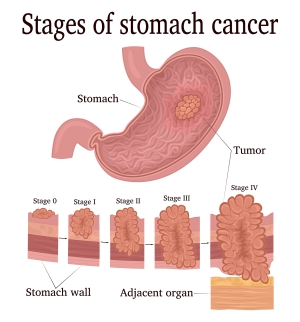 胃癌的分期
